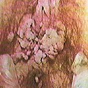 Condiloma Vaginal