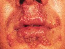Herpes Labial